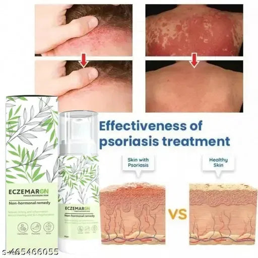 Anti Fungal Eczema Cream | (Buy 1 Get 1 Free)