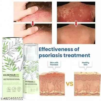 Anti Fungal Eczema Cream | (Buy 1 Get 1 Free)